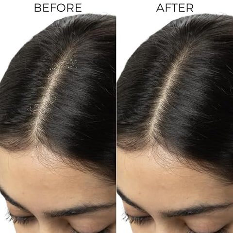 Brillaire Dandruff Control Scalp Serum Mist 50Ml