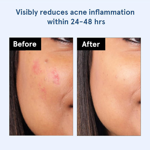 Bodywise Be Bodywise Acne Pimple Patch For Women (24 Dots | 3 Sizes) For All Skin Type